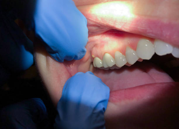 Best Chipped Tooth Repair Near Me  in Centerport, NY